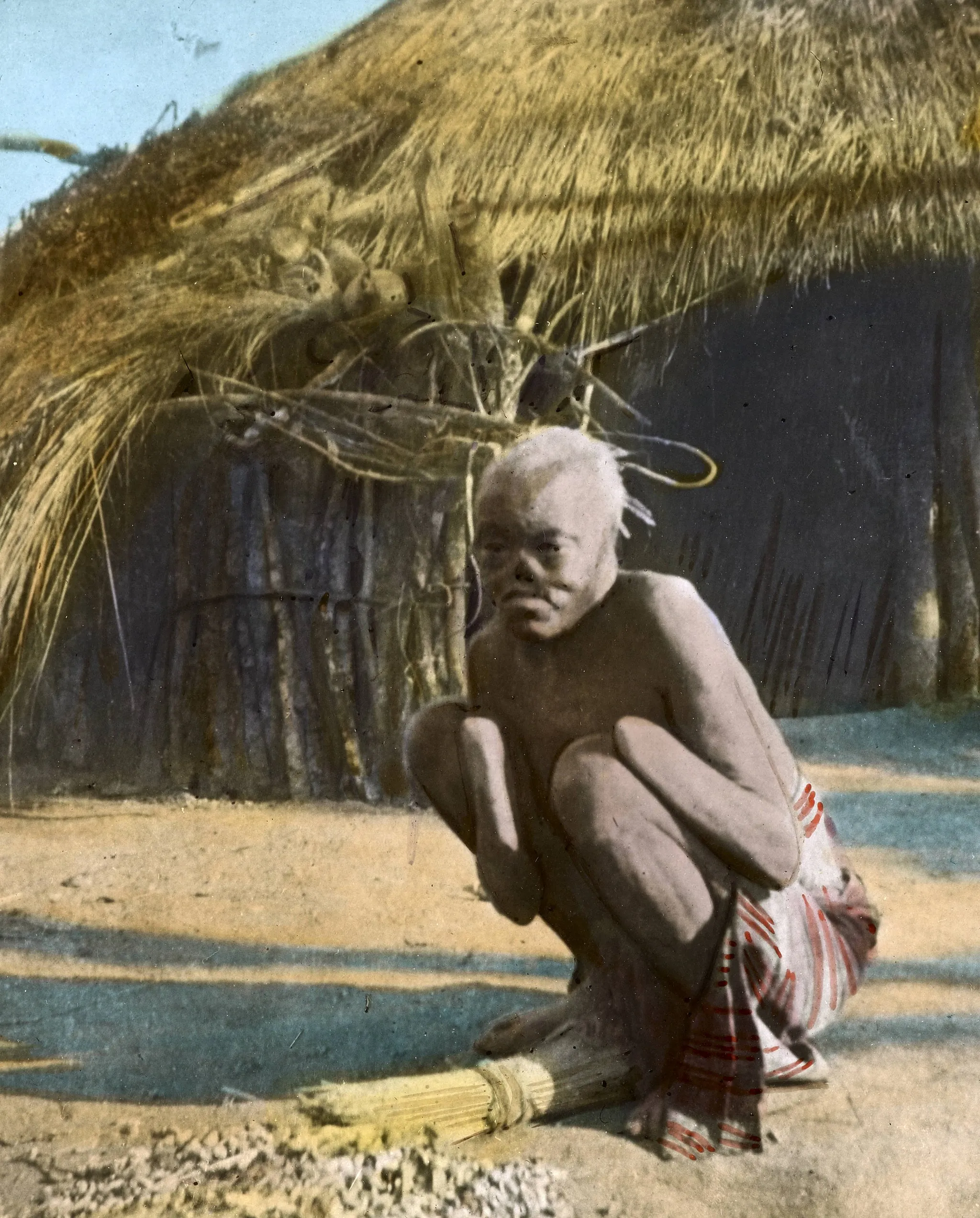 Photo showing: "A mutilated victim of Wemba savagery, Livingstonia", ca.1910
Photograph of a man squatting on the ground outside a thatched hut.  The man has lost both of his hands and his nose.; This belongs to a series of Church of Scotland Foreign Missions Committee lantern slides relating to Rev Donald Fraser (1870-1933). Rev Donald Fraser, the Scottish missionary, was born in Argyllshire, Scotland, the son of a Free Church minister.  In his youth Rev Fraser helped found the Student Volunteer Movement in Britain and the World Student Christian Federation before beginning missionary service in Malawi with the Free Church of Scotland.  He worked in Malawi from 1896 until he returned to Scotland in 1925.  He was first posted to Ekwendeni and later Embangweni.  Rev Fraser worked closely with the Ngoni people. Photographer: Unknown
Filename: imp-cswc-GB-237-CSWC47-LS4-1-020.tif
Coverage date: circa 1910
Part of collection: International Mission Photography Archive, ca.1860-ca.1960
Type: images
Part of subcollection: Photographs from the Centre for the Study of World Christianity, University of Edinburgh, U.K., ca.1900-ca.1940s
Repository name: Centre for the Study of World Christianity
Archival file: impaunpub_Volume7/1469.url
Repository address: The University of Edinburgh School of Divinity, New College, Mound Place, Edinburgh EH1 2LX, United Kingdom
Geographic subject (country): Zambia
Format (aacr2): 1 lantern slide : 8 x 8 cm.
Geographic subject (continent): Africa
Rights: Contact the repository for details.
Part of series: Donald Fraser of Loudon LS4/1
Repository email: divinity-CSWC@ed.ac.uk
Subject (lcsh Keyword): War wounds; Tribes
Date created: circa 1910
Publisher (of the digital version): University of Southern California. Libraries
Subject (aat genre): exterior views
Format (aat): lantern slides
Legacy record ID: impa-m68517
Access conditions: http://www.ed.ac.uk/schools-departments/divinity/research/centres/world-christianity/collections-resources
File: GB 237 CSWC47/LS4/1/20