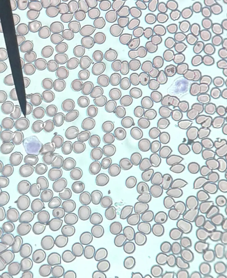 Photo showing: Human blood. You can see red and white blood cells, with and without nuclei, respectively. Giemsa stain